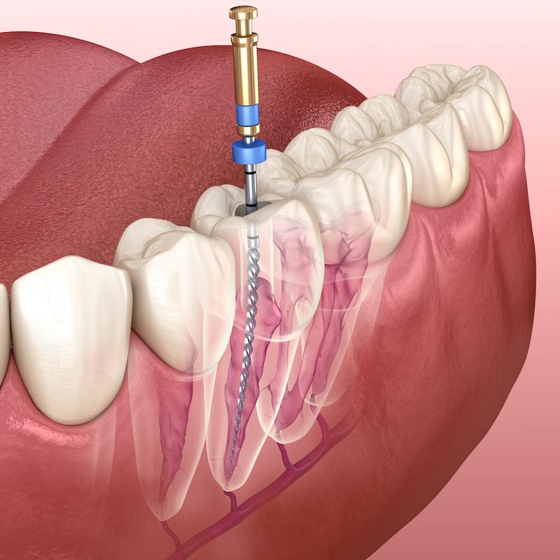 Endodonție image 1